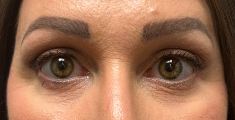 Upper Eyelid Blepharoplasty Before & After Gallery - Patient 751623 - Image 2