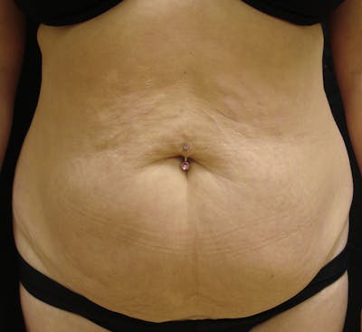 Abdominoplasty and Body Contouring Before & After Gallery - Patient 753743 - Image 1