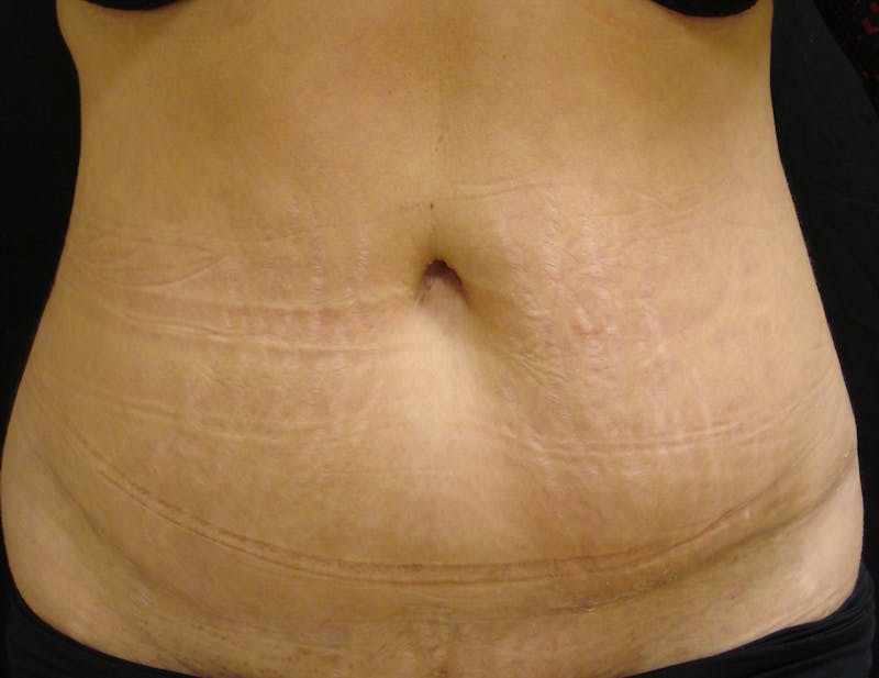 Abdominoplasty and Body Contouring Before & After Gallery - Patient 753743 - Image 2