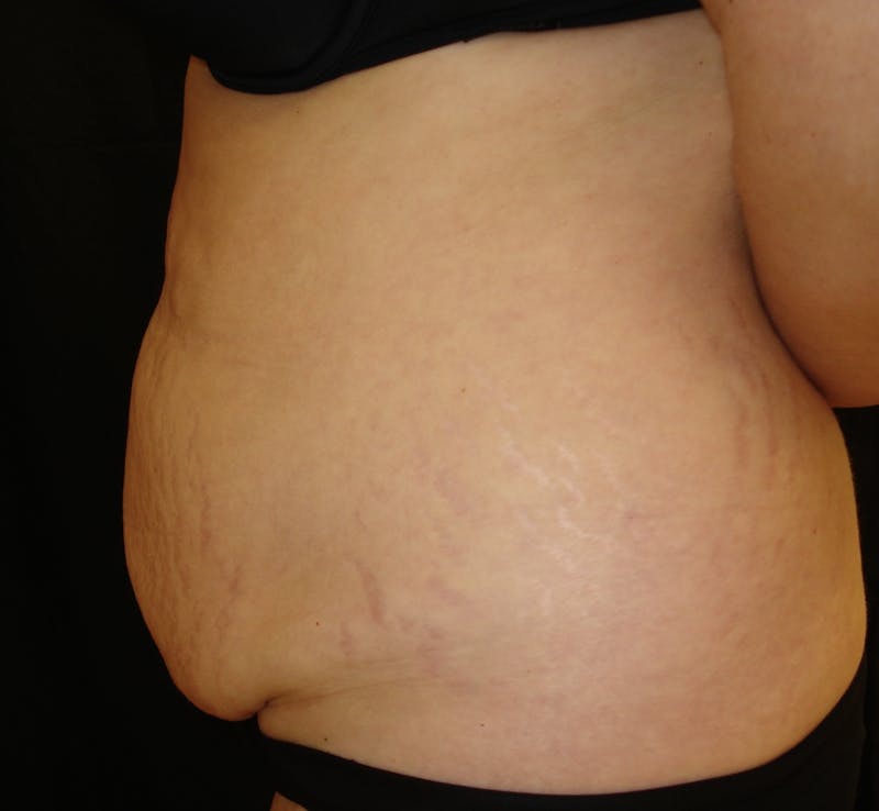 Abdominoplasty and Body Contouring Before & After Gallery - Patient 753743 - Image 3