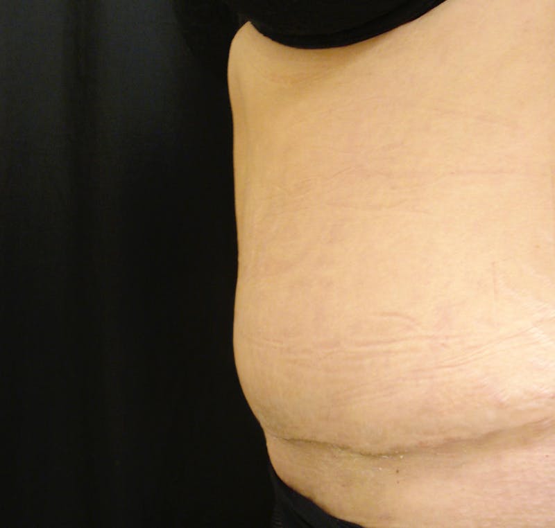 Abdominoplasty and Body Contouring Before & After Gallery - Patient 753743 - Image 4