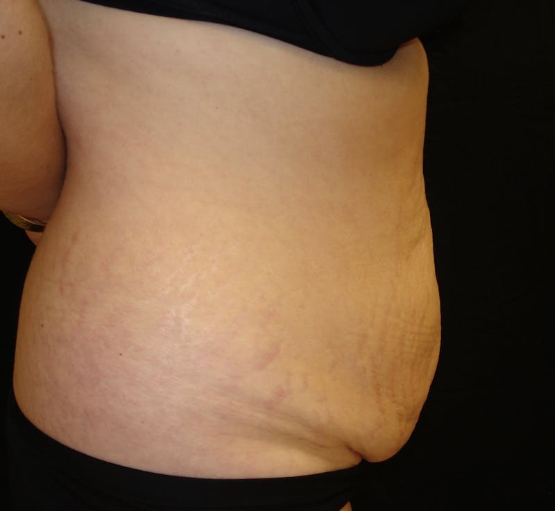 Abdominoplasty and Body Contouring Before & After Gallery - Patient 753743 - Image 5