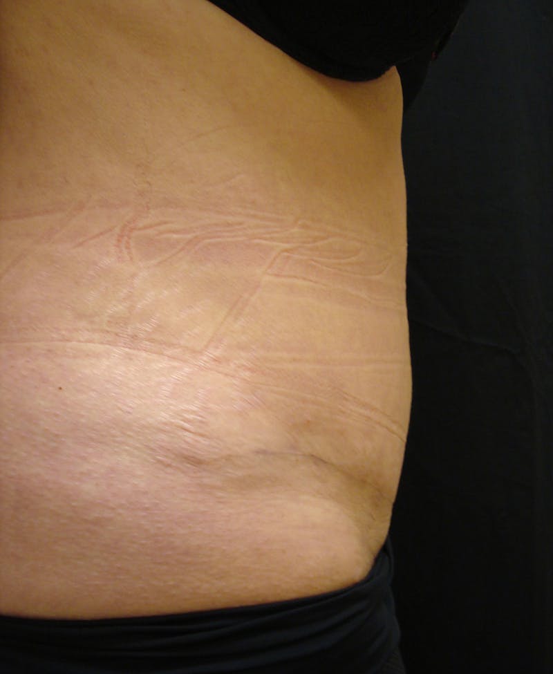 Abdominoplasty and Body Contouring Before & After Gallery - Patient 753743 - Image 6