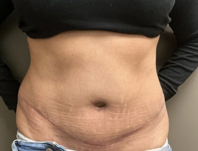 Abdominoplasty and Body Contouring Before & After Gallery - Patient 159793 - Image 1
