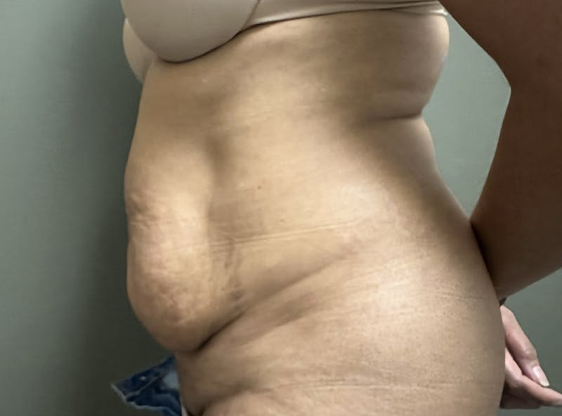 Abdominoplasty and Body Contouring Before & After Gallery - Patient 159793 - Image 2