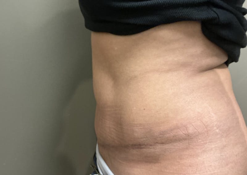 Abdominoplasty and Body Contouring Before & After Gallery - Patient 159793 - Image 3