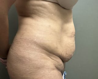 Abdominoplasty and Body Contouring Before & After Gallery - Patient 159793 - Image 4