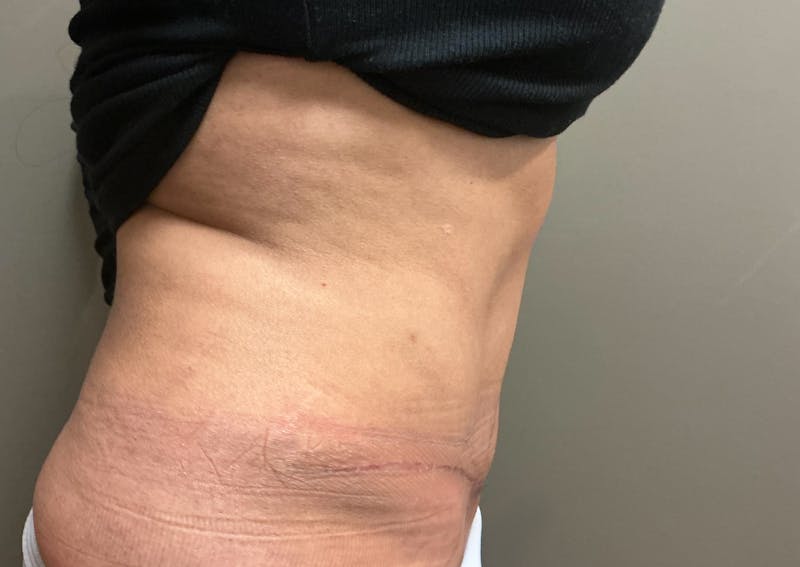 Abdominoplasty and Body Contouring Before & After Gallery - Patient 159793 - Image 5