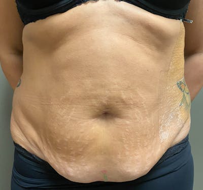 Abdominoplasty and Body Contouring Before & After Gallery - Patient 133947 - Image 1
