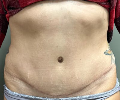 Abdominoplasty and Body Contouring Before & After Gallery - Patient 133947 - Image 2