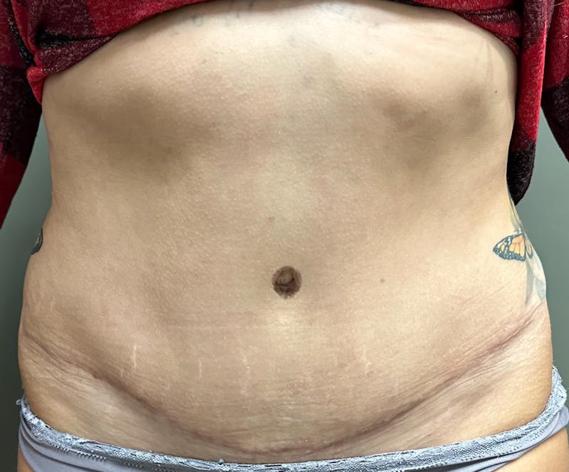 Abdominoplasty and Body Contouring Before & After Gallery - Patient 133947 - Image 2
