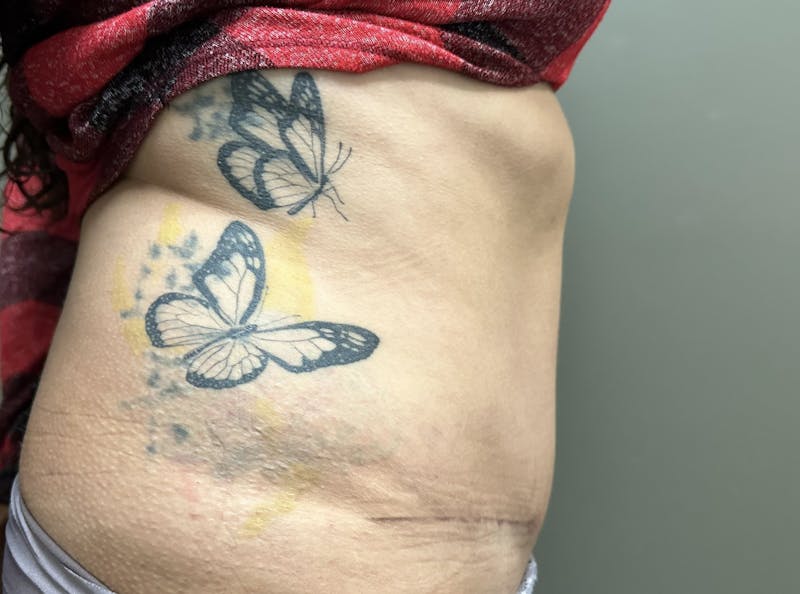 Abdominoplasty and Body Contouring Before & After Gallery - Patient 133947 - Image 4