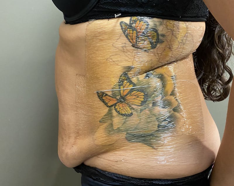 Abdominoplasty and Body Contouring Before & After Gallery - Patient 133947 - Image 5