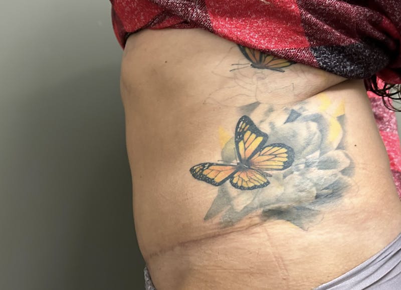 Abdominoplasty and Body Contouring Before & After Gallery - Patient 133947 - Image 6