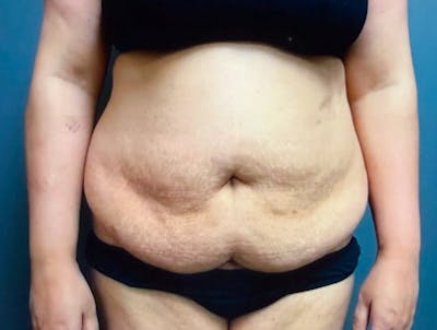 Abdominoplasty and Body Contouring Before & After Gallery - Patient 661104 - Image 1