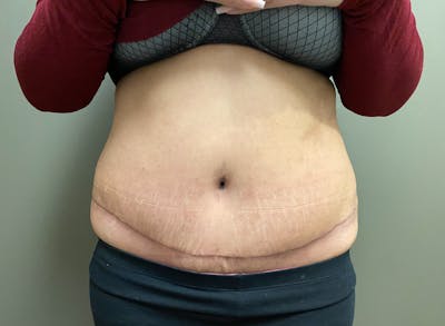 Abdominoplasty and Body Contouring Before & After Gallery - Patient 661104 - Image 2