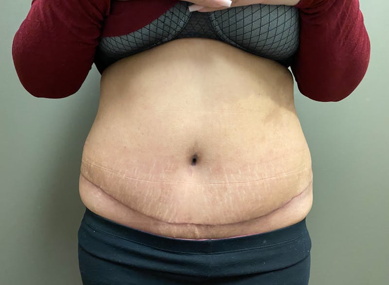 Abdominoplasty and Body Contouring Before & After Gallery - Patient 661104 - Image 2