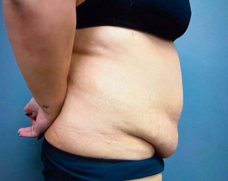 Abdominoplasty and Body Contouring Before & After Gallery - Patient 661104 - Image 3