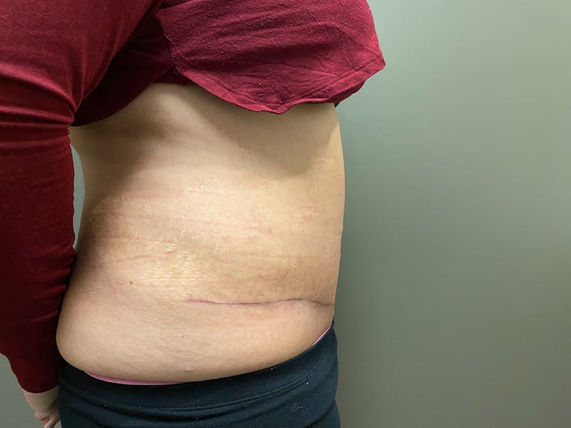 Abdominoplasty and Body Contouring Before & After Gallery - Patient 661104 - Image 4