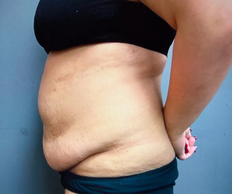 Abdominoplasty and Body Contouring Before & After Gallery - Patient 661104 - Image 5