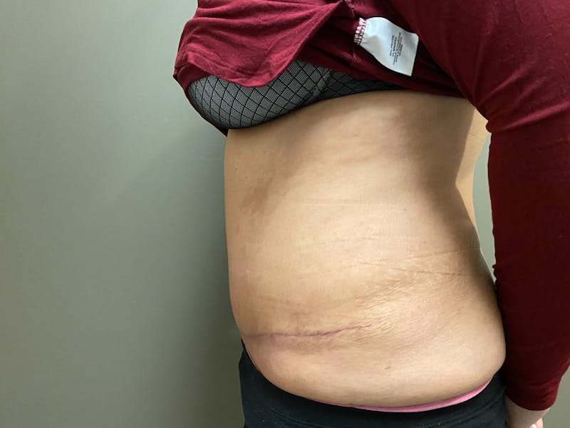 Abdominoplasty and Body Contouring Before & After Gallery - Patient 661104 - Image 6