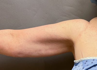 Brachioplasty-Arm Lift Before & After Gallery - Patient 297064 - Image 1
