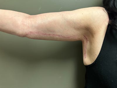 Brachioplasty-Arm Lift Before & After Gallery - Patient 297064 - Image 2