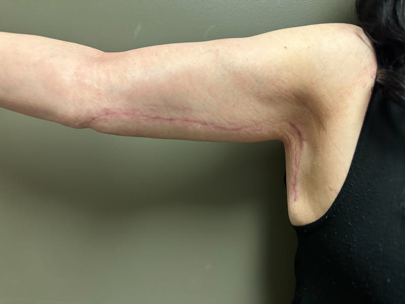 Brachioplasty-Arm Lift Before & After Gallery - Patient 297064 - Image 2