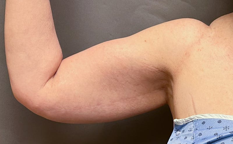 Brachioplasty-Arm Lift Before & After Gallery - Patient 297064 - Image 3