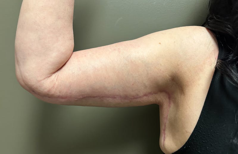 Brachioplasty-Arm Lift Before & After Gallery - Patient 297064 - Image 4