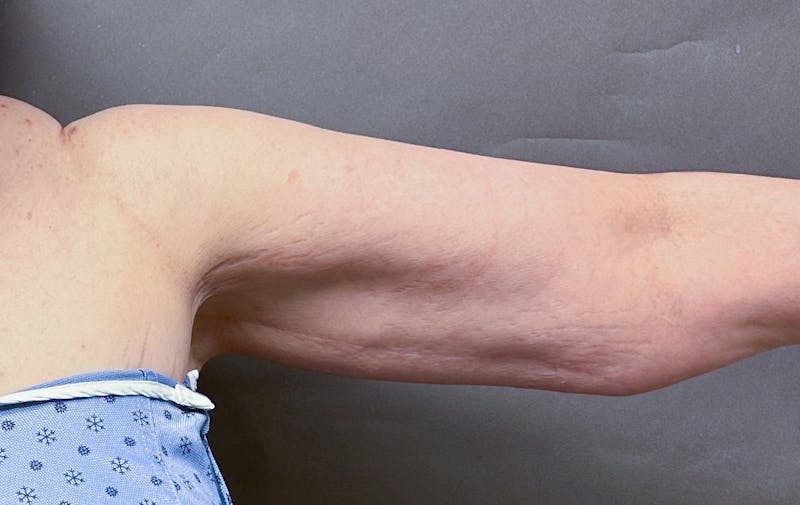 Brachioplasty-Arm Lift Before & After Gallery - Patient 297064 - Image 5