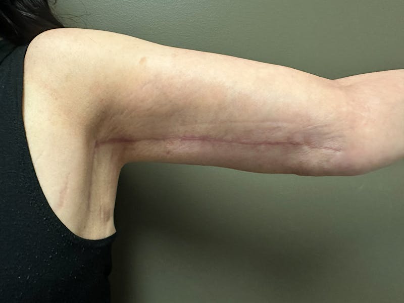 Brachioplasty-Arm Lift Before & After Gallery - Patient 297064 - Image 6