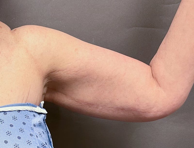 Brachioplasty-Arm Lift Before & After Gallery - Patient 297064 - Image 7