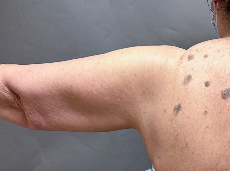 Brachioplasty-Arm Lift Before & After Gallery - Patient 297064 - Image 9