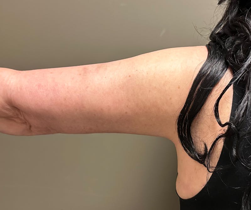 Brachioplasty-Arm Lift Before & After Gallery - Patient 297064 - Image 10