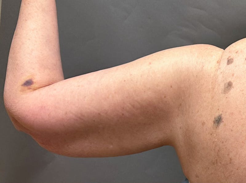Brachioplasty-Arm Lift Before & After Gallery - Patient 297064 - Image 11