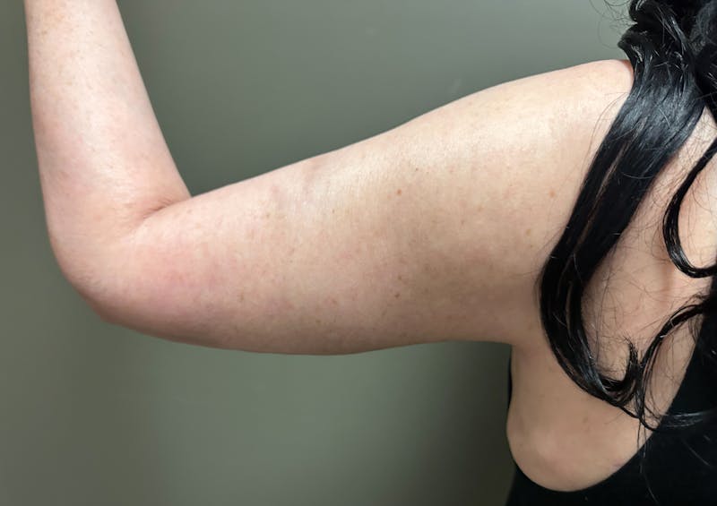 Brachioplasty-Arm Lift Before & After Gallery - Patient 297064 - Image 12