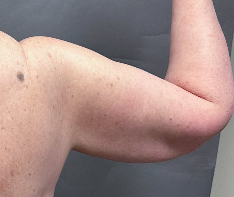 Brachioplasty-Arm Lift Before & After Gallery - Patient 297064 - Image 13