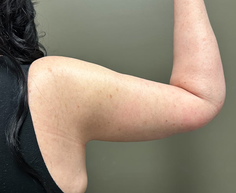 Brachioplasty-Arm Lift Before & After Gallery - Patient 297064 - Image 14