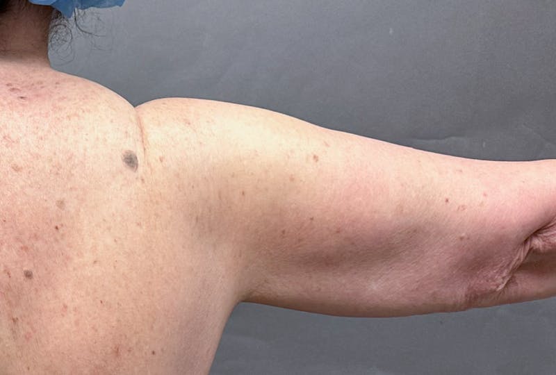Brachioplasty-Arm Lift Before & After Gallery - Patient 297064 - Image 15