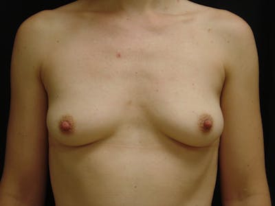 Breast Augmentation Before & After Gallery - Patient 598562 - Image 1