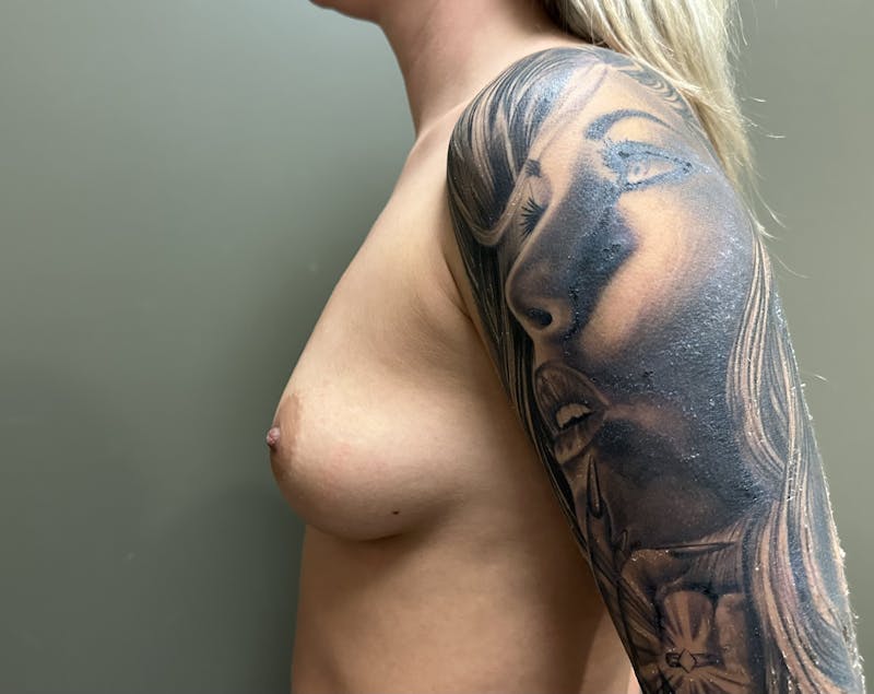 Breast Augmentation Before & After Gallery - Patient 399370 - Image 3