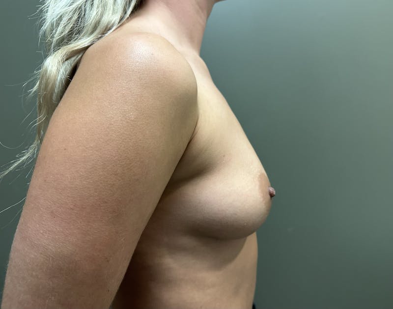 Breast Augmentation Before & After Gallery - Patient 399370 - Image 5