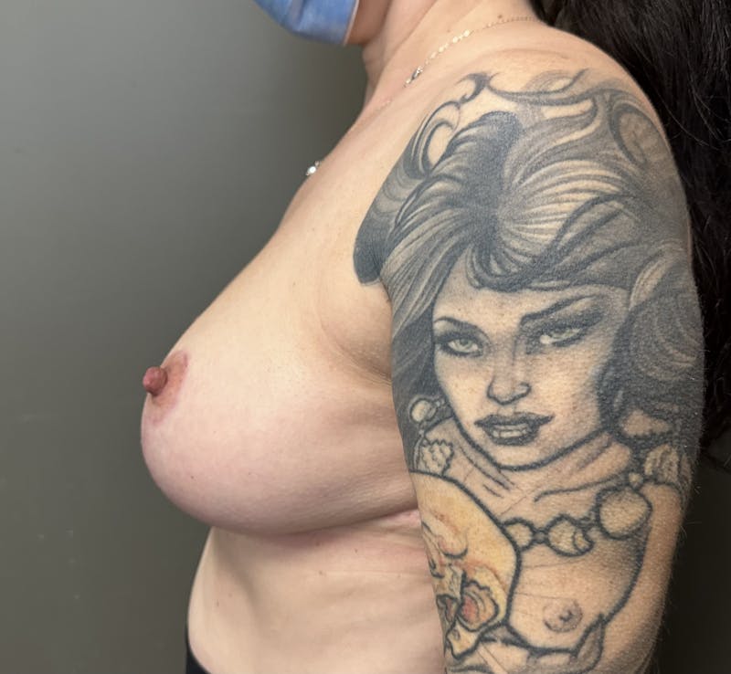 Breast Reduction and Lift Before & After Gallery - Patient 391054 - Image 4