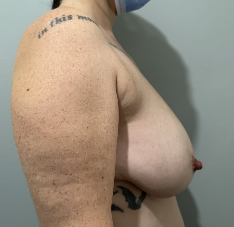 Breast Reduction and Lift Before & After Gallery - Patient 391054 - Image 5