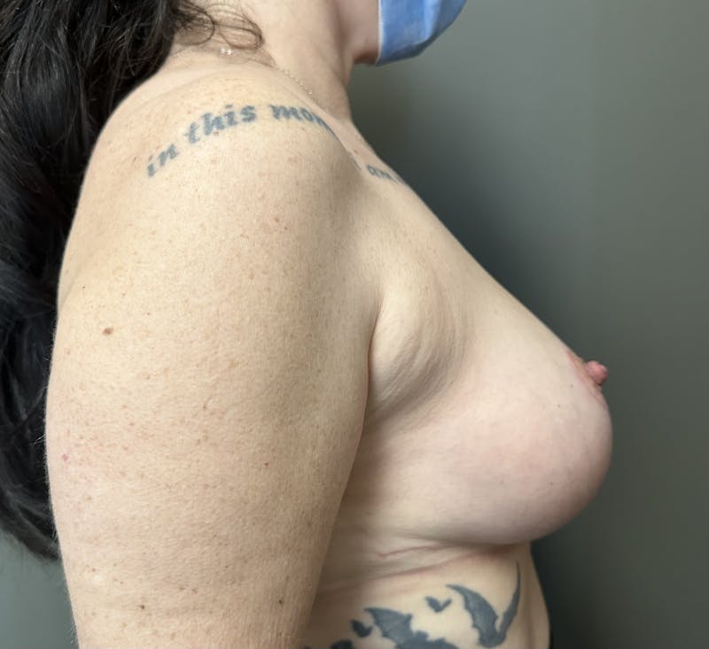 Breast Reduction and Lift Before & After Gallery - Patient 391054 - Image 6