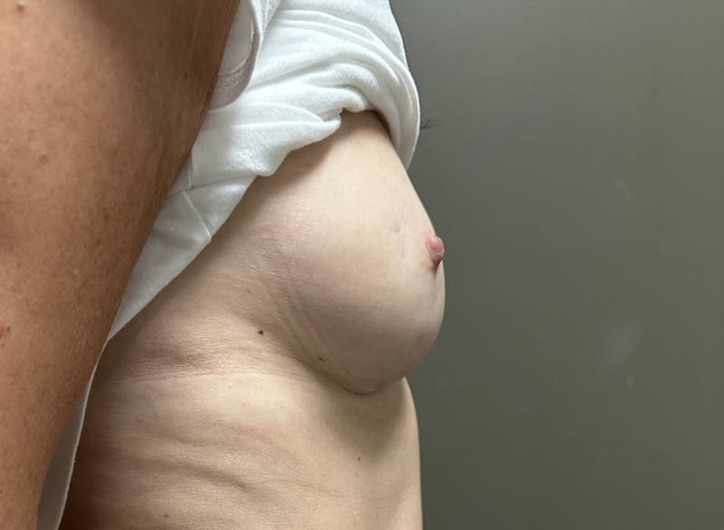 Breast Reduction and Lift Before & After Gallery - Patient 973935 - Image 6