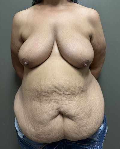 Combined Breast and Abdomen Before & After Gallery - Patient 426459 - Image 1
