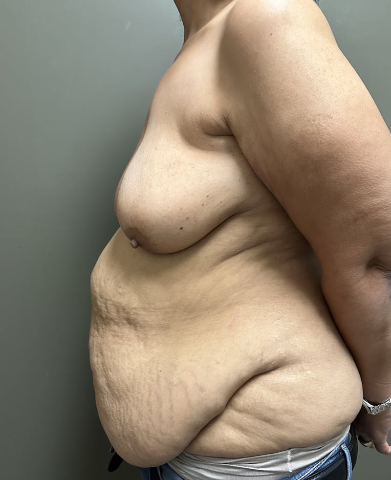 Combined Breast and Abdomen Before & After Gallery - Patient 426459 - Image 3