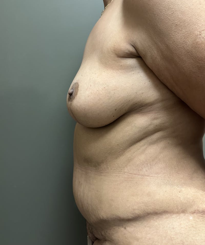 Combined Breast and Abdomen Before & After Gallery - Patient 426459 - Image 4